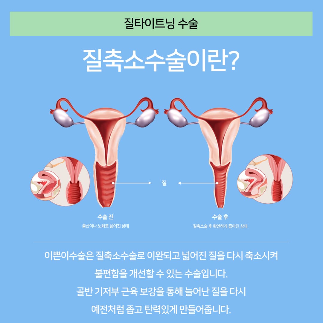 삼성산부인과 질방귀원인 해결 질타이트닝 수술 금방 되돌아가나요?