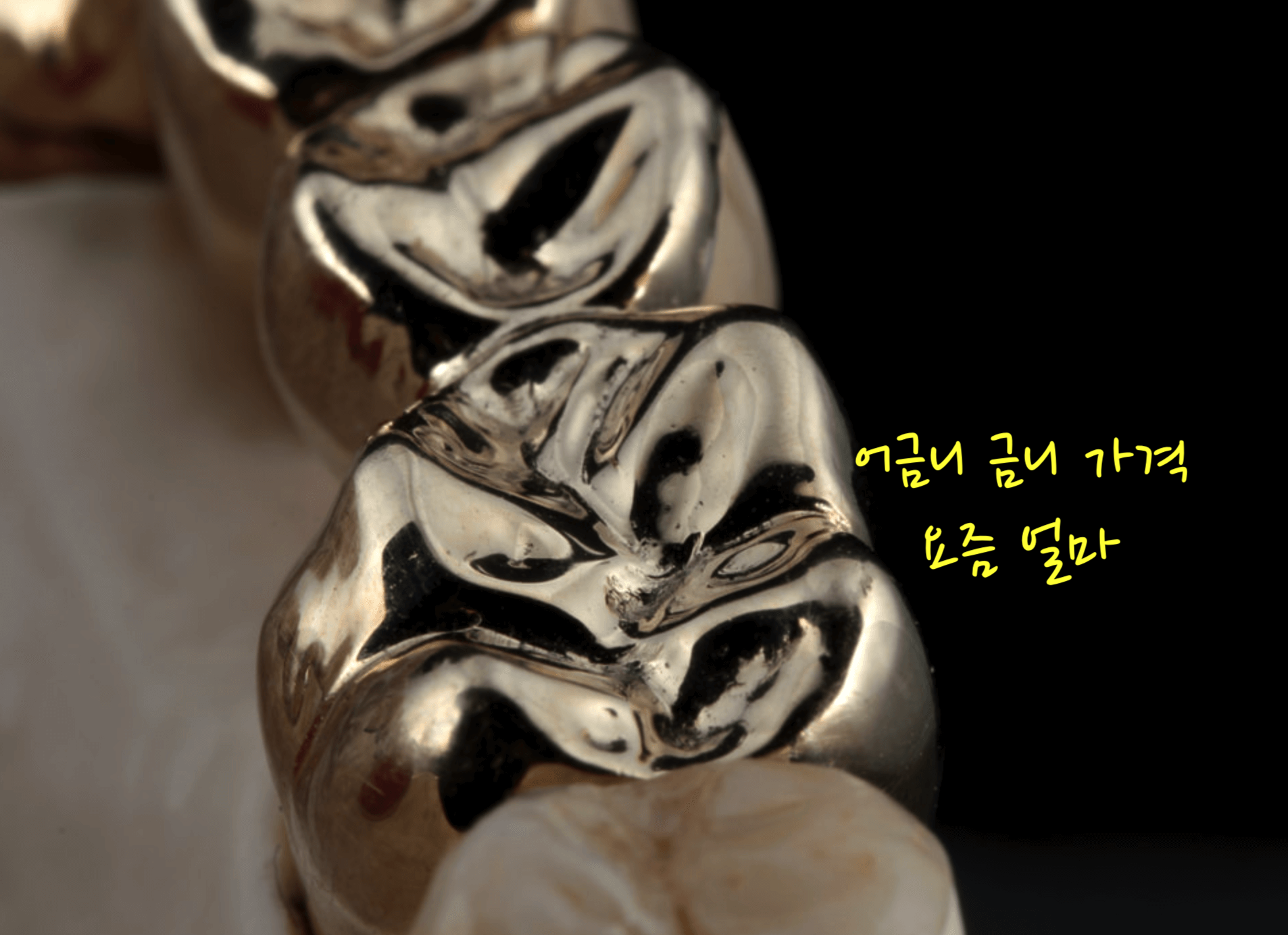 어금니 금니 가격