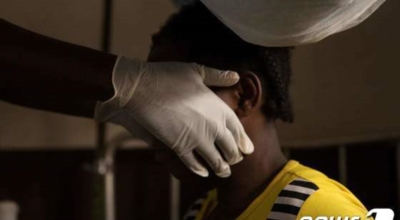 원숭이두창 이미지