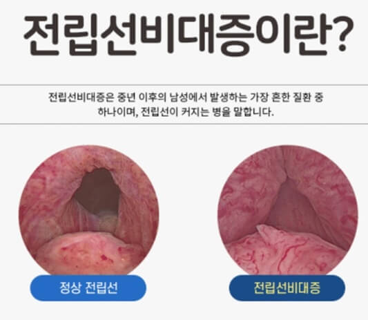 전립선비대증