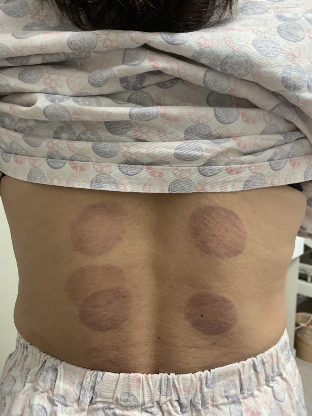 뜸치료 &amp; 부항치료