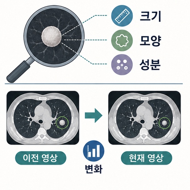 폐결절의 크기와 모양, 성분, 이전 CT와 비교한 성장 여부를 확인하는 그림
