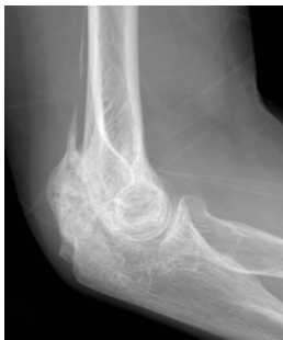 팔꿈치 강직 사진출처 대한정형외과 학회 홈페이지