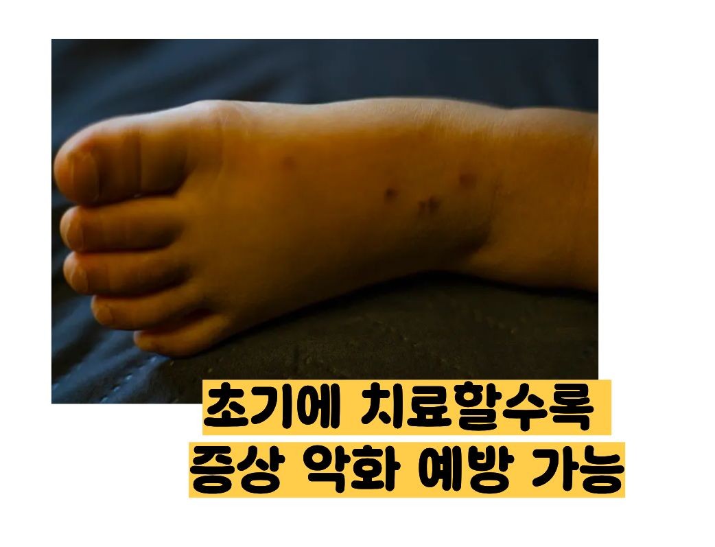 건선 초기증상