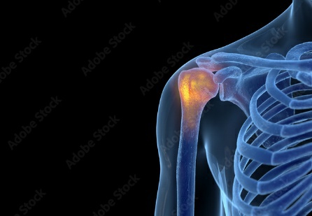 오십견 어깨 사진