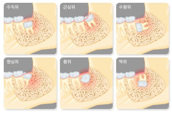 사랑니 발치