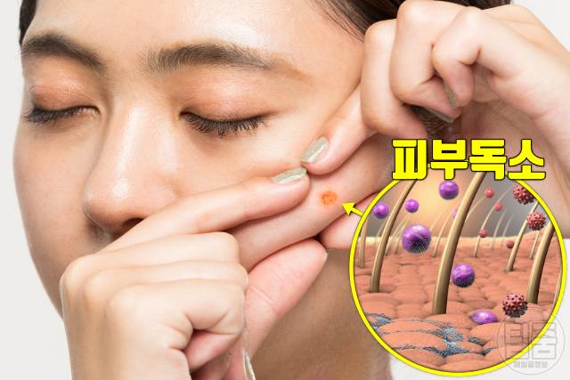 몸속 독소 배출 몸독소증상 여드름 발진