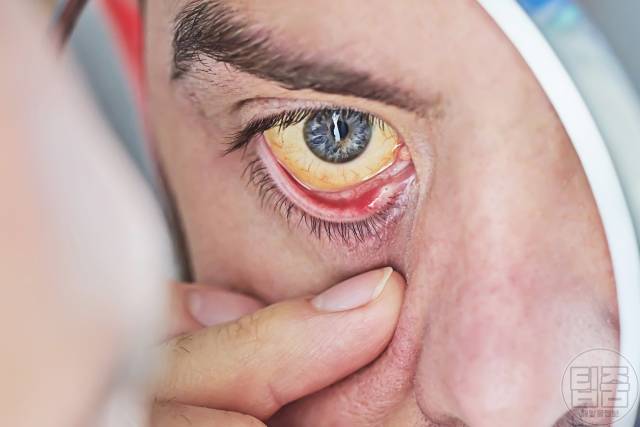 담석증 증상 초기증상 노란피부 황달 눈흰자