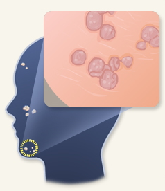 얼굴-편평-사마귀-사진