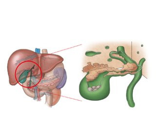 담도암 진단 및 치료