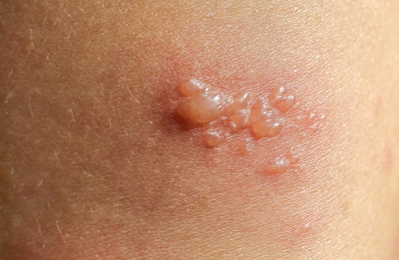 봄철 대상포진 유행 (면역력, 증상, 대처법)