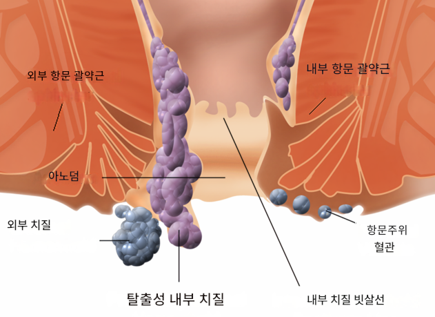 임신 중 치질, 왜 생기는 걸까요?