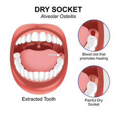 Dry socket