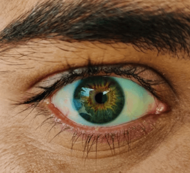 녹내장 초기증상 - 안압 낮추기