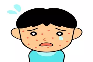 대상포진 예방접종 가격