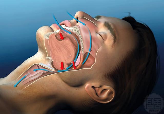 수명단축 잠자는 습관 코골이