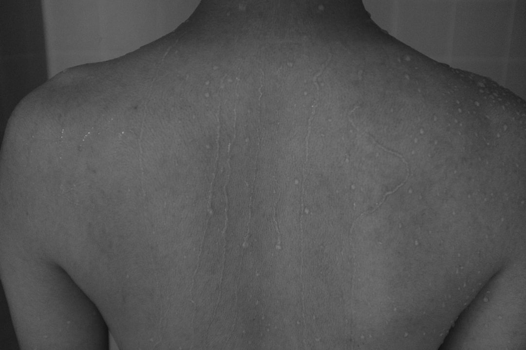 Atopic dermatitis.