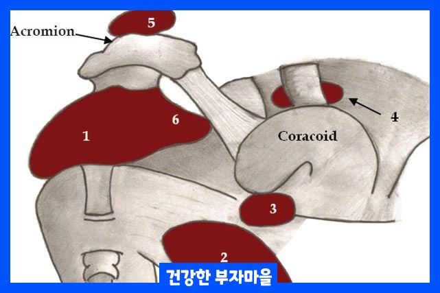 어깨 높이 이상 팔을 들기 어려운 증상