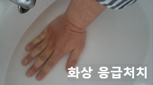 기름에 손 데었을때 약