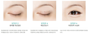 여자 무쌍 눈매 교정