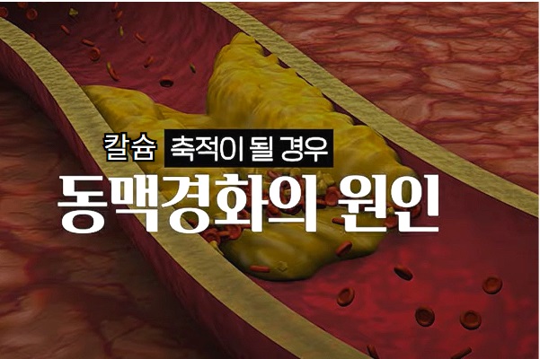 비타민 K2 - 동맥경화 혈관 모습