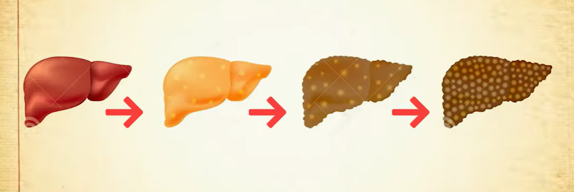 지방간 없애는 방법