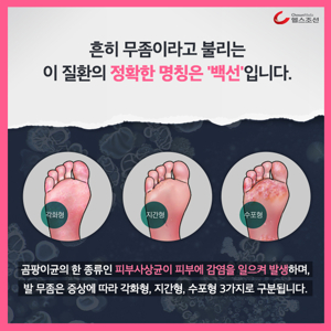 발바닥갈라짐