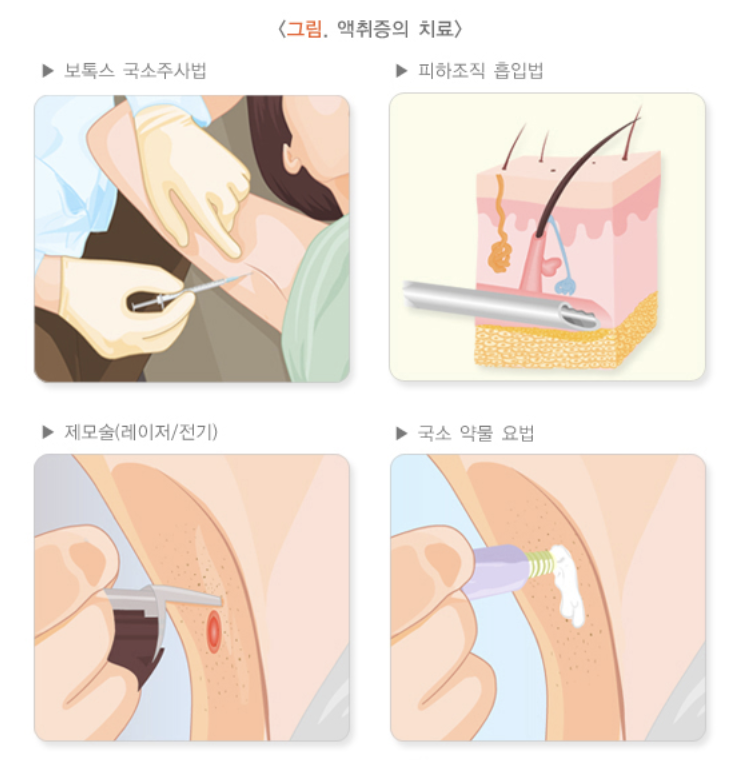 액취증 치료