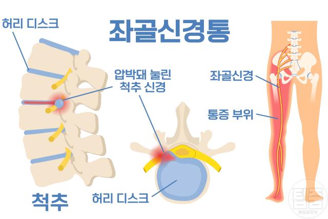 골반통증 원인 좌골신경통 증상 한쪽다리통증