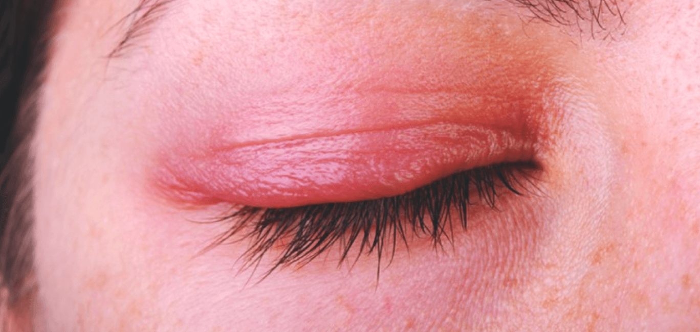 눈 두덩이 염증