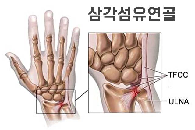 넘어져서 손목이 부었을때 손목통증 삼각섬유연골파열 증상