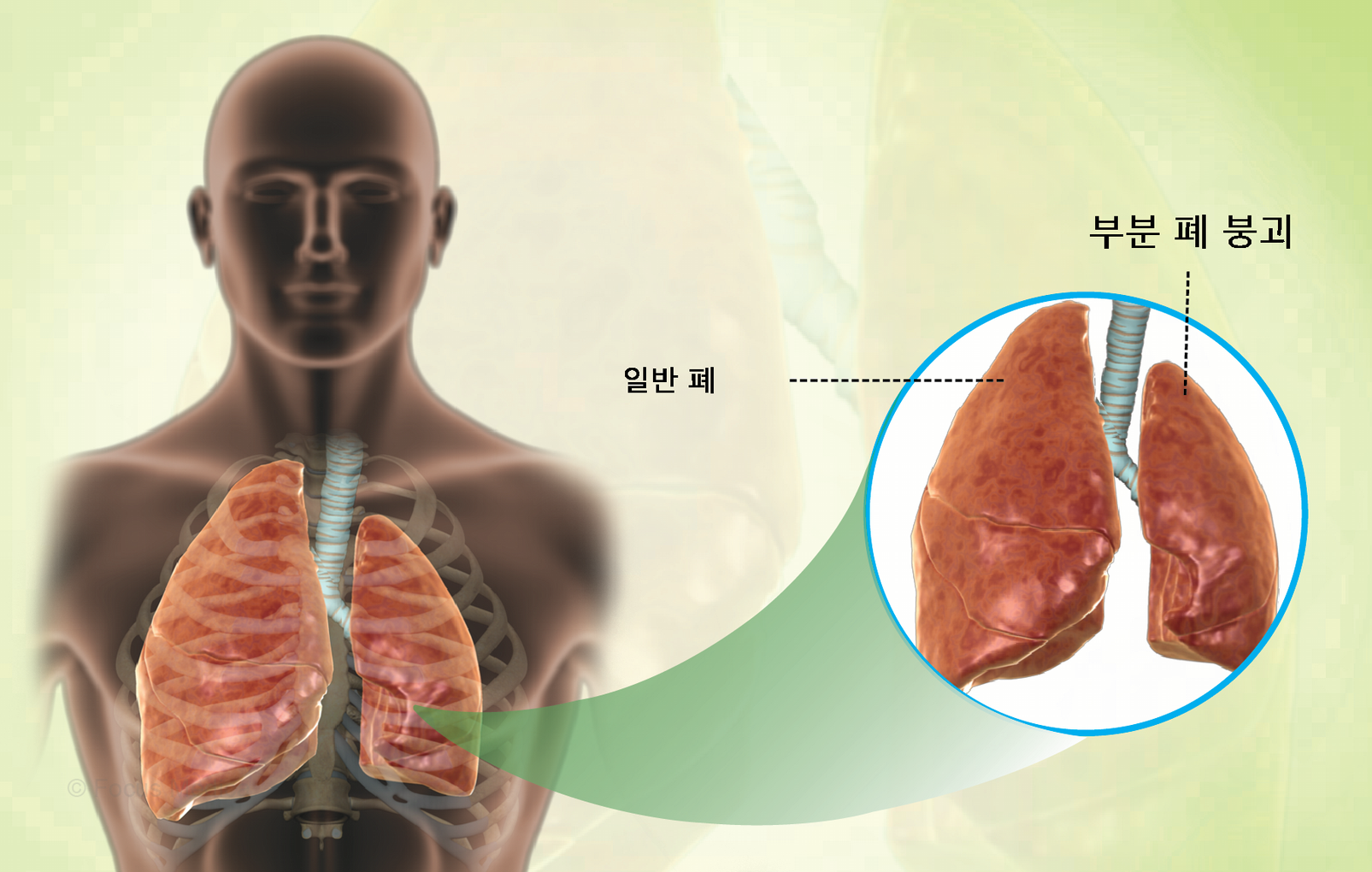 무기폐 사진/ 출처 -https://www.msn.com/