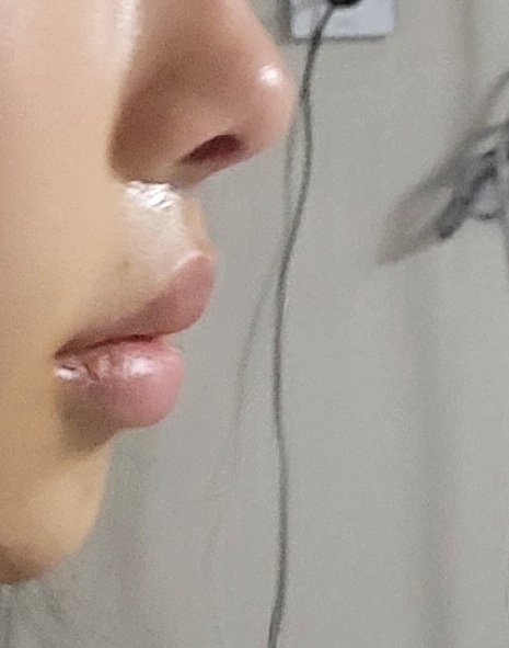 인중 축소 수술 후기