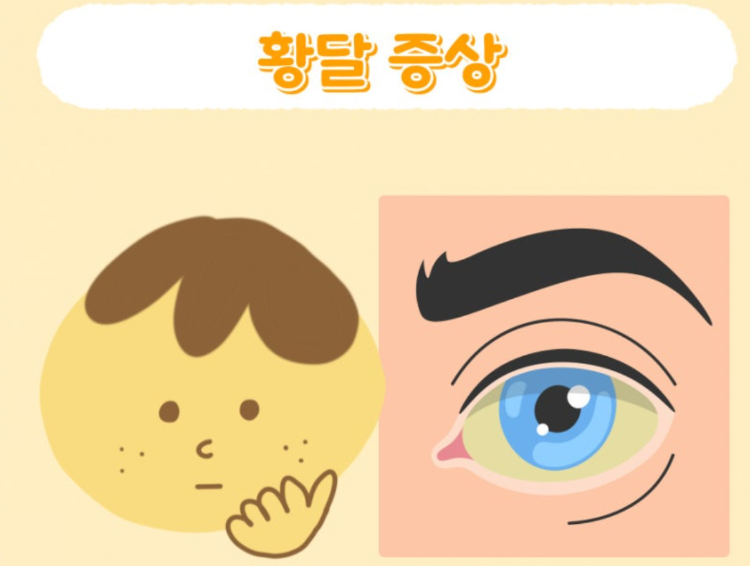 황달의-증상