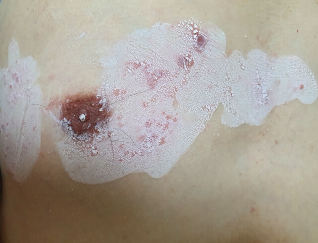 신장이식환자의 주의점