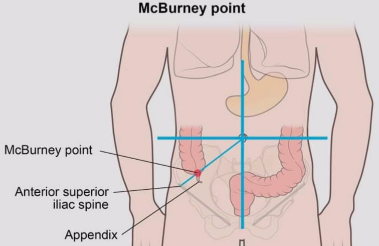 맹장위치-맥버니점