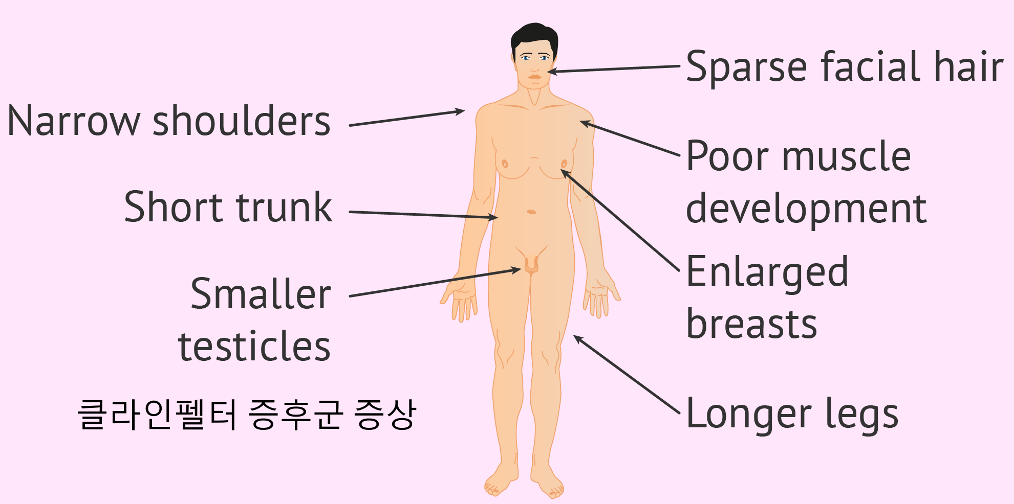 클라인펠터 증후군