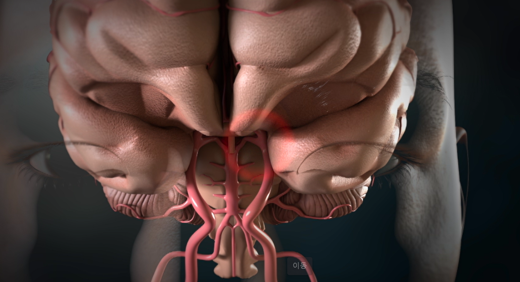 명의 뇌 뇌동맥류