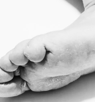 겨울철-발-각질-굳은-살-해결-방법