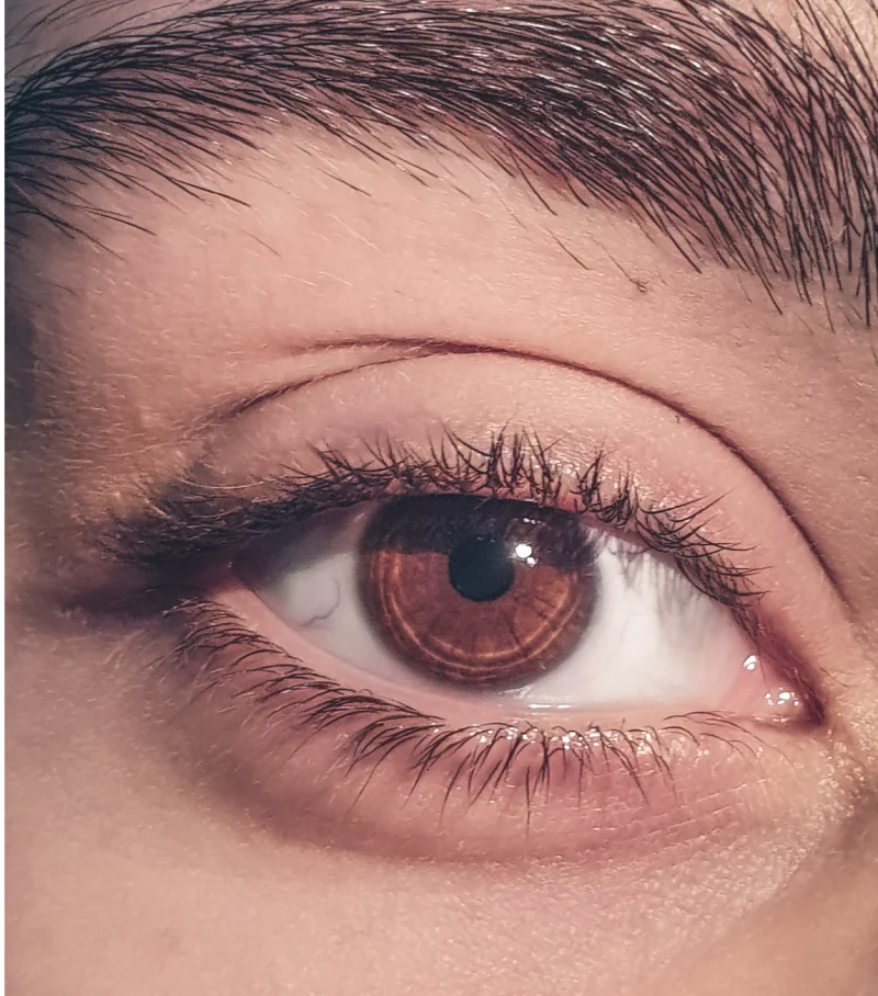 마판증후군 눈 수정체 