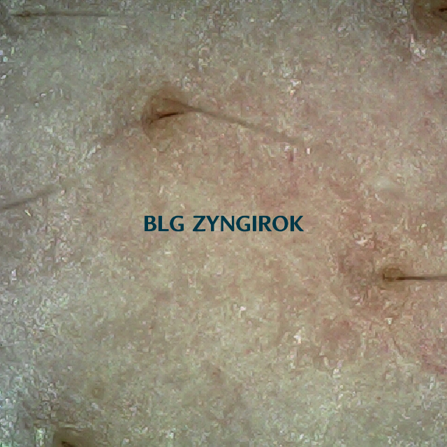 탈모 극복 프로젝트 - 오른쪽 M자 부위 두피 모습이다.