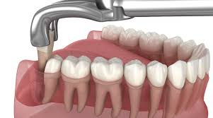 사랑니 발치 후 식사 가이드