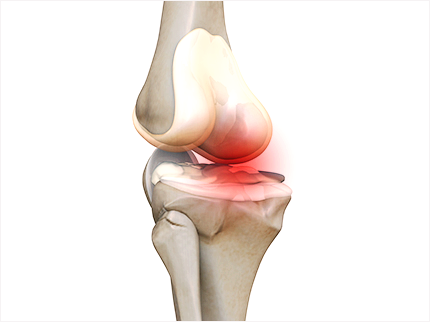 콘드로이친 효능 부작용