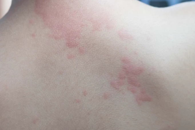 대상포진-초기증상-건강