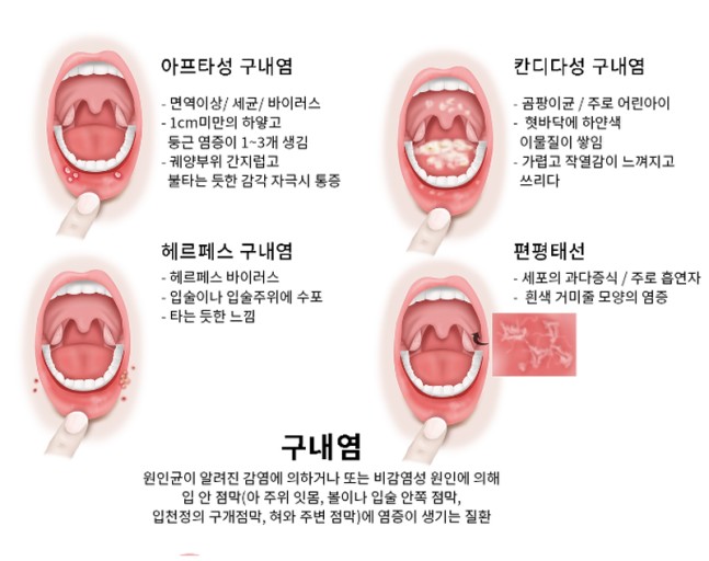 혀 통증 원인 혓바늘이 돋는 이유 혀 끝, 옆, 밑, 안쪽, 뿌리