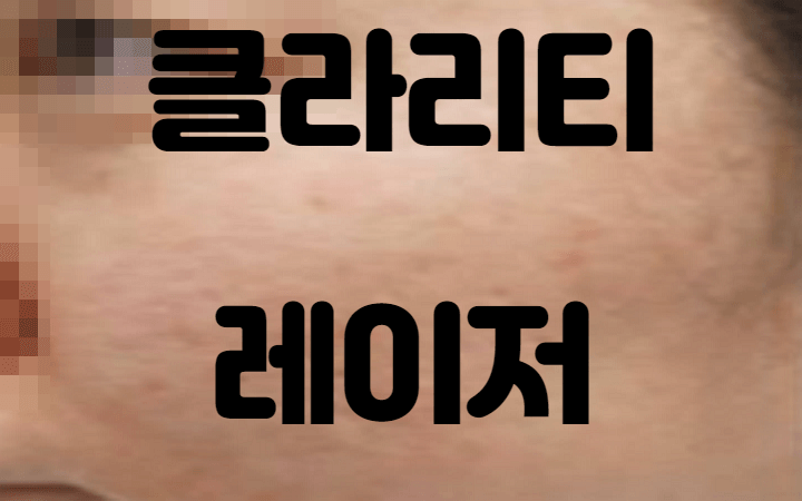 넓은 모공, 색소 침착을 가지고 있는 얼굴의 상태