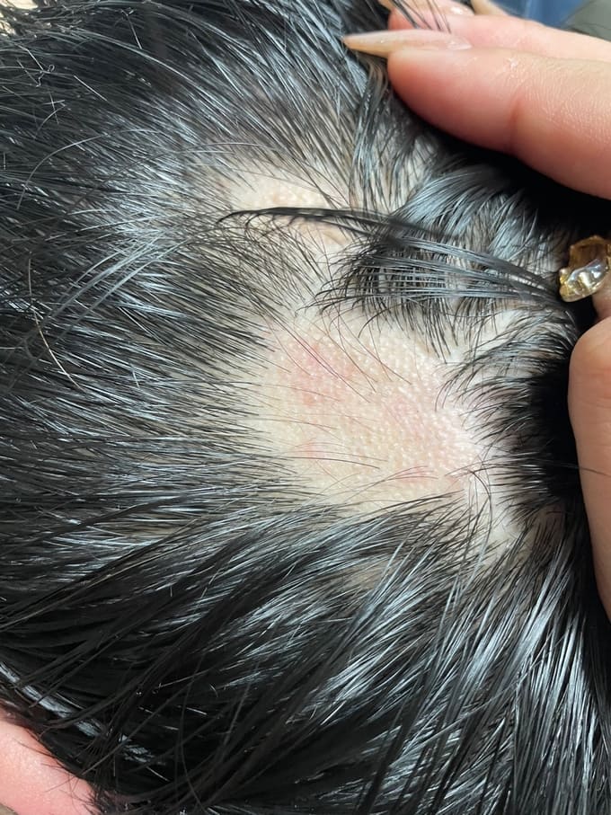 이런 어쩌나!...접종 후 탈모, 직장도 그만두고 여친과도 이별...우울증 심해져