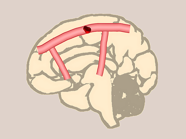 허혈성-뇌졸중-모습