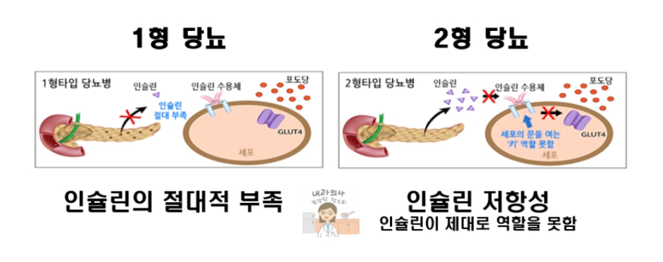 당뇨의 유형 설명 이미지