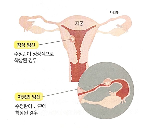 자궁외임신
